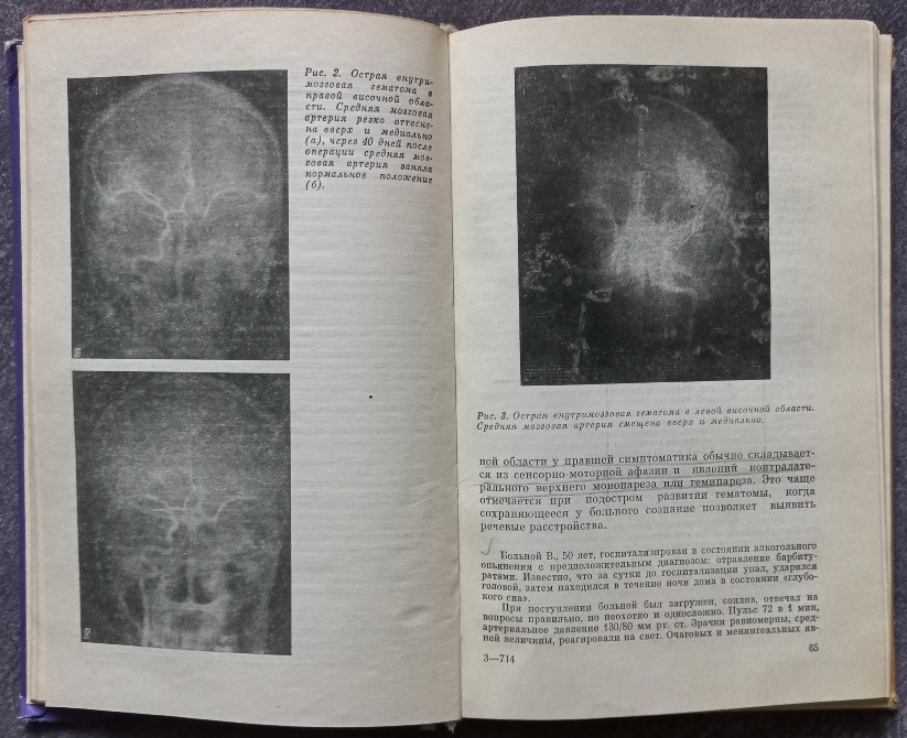 Острые травматические внутричерепные гематомы. Ю.В. Исаков Харьков - изображение 3