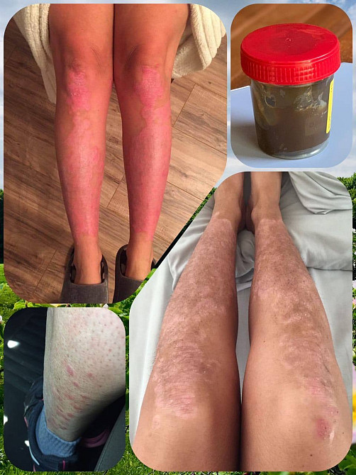 🌿 Натуральное лечение псориаза! Мазь, созданная специально для вас! Одеса - зображення 1