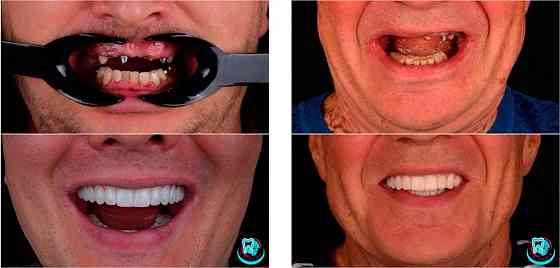 Високоякісна імплантація зубних імплантів у місті Київ - Са-Ната Киев