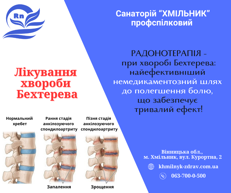 Лікування хвороби Бехтерева у санаторії «Хмільник» Хмельник - изображение 1