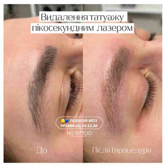 Видалення татуюваннь та татуажу(брови, повіки, губи) Киев