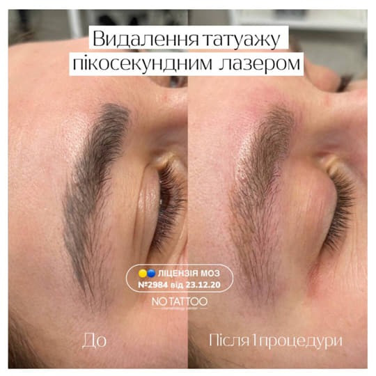Видалення татуюваннь та татуажу(брови, повіки, губи) Киев - изображение 1