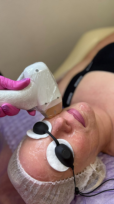 Лазерного омоложения лица в Каменском Київ - зображення 2