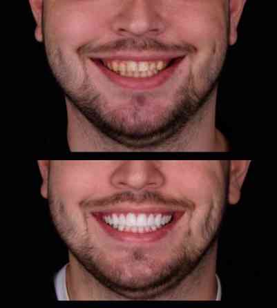 Сучасні вініри усіх типів у Києві - стоматологія Sa-Nata Київ