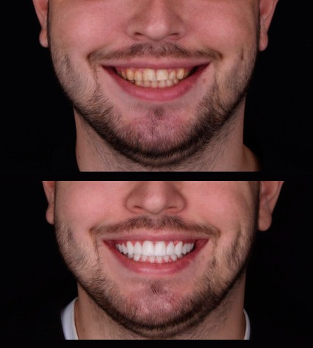 Сучасні вініри усіх типів у Києві - стоматологія Sa-Nata Київ - зображення 2