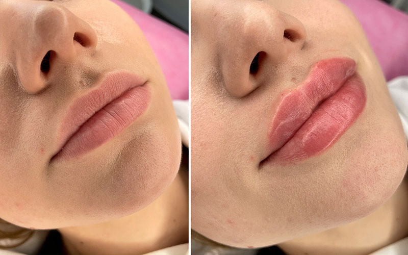 Контурування губ - вирівнювання і збільшення Киев - изображение 1