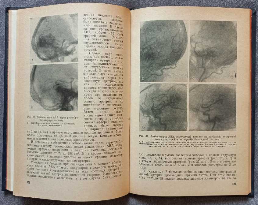 Внутрисосудистая нейрохирургия. В.А. Хилько, Ю.Н. Зубков Харьков - изображение 6