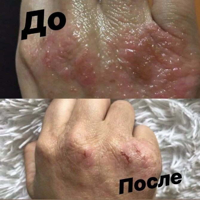 🌿 Натуральное лечение псориаза! Мазь, созданная специально для вас! Одеса - зображення 2