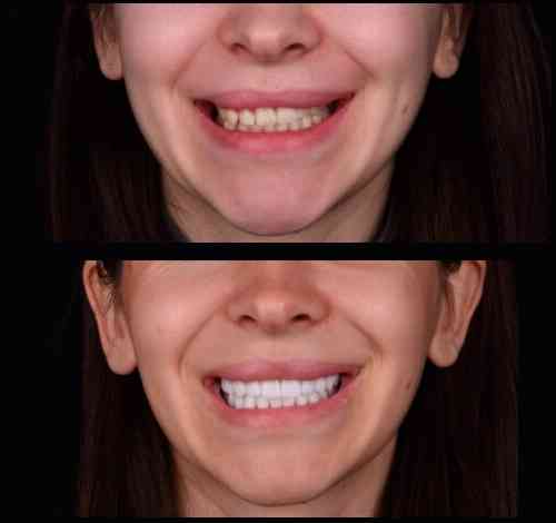 Сучасні вініри усіх типів у Києві - стоматологія Sa-Nata Київ