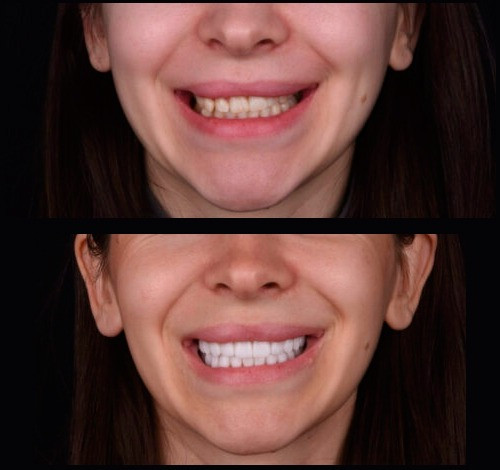 Сучасні вініри усіх типів у Києві - стоматологія Sa-Nata Київ - зображення 3