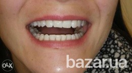 Экспресс отбеливание зубов за 21 минуту Pearlsmile-Kiev Київ - зображення 3