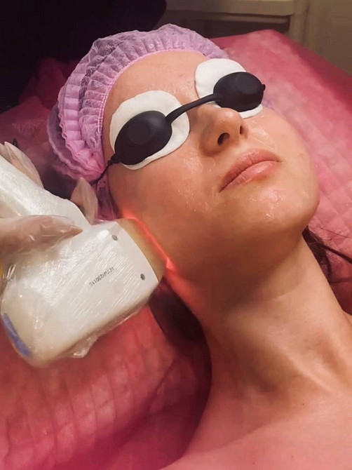 Лазерного омоложения лица в Каменском Київ - зображення 1