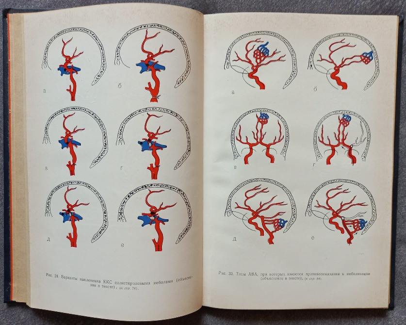 Внутрисосудистая нейрохирургия. В.А. Хилько, Ю.Н. Зубков Харьков - изображение 3
