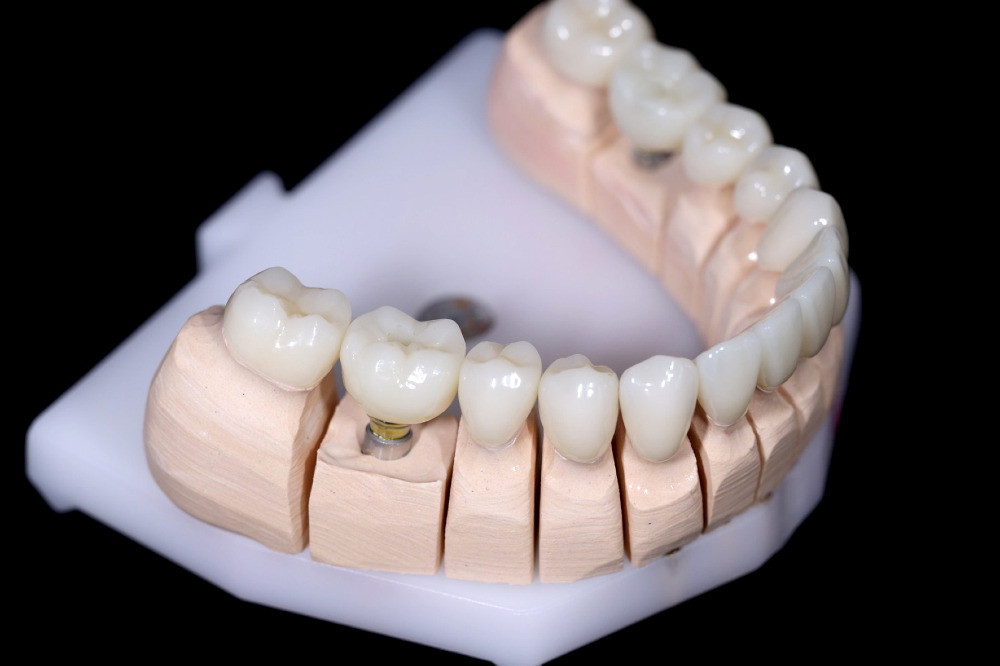 Зуботехнічні роботи для всієї України: фрезерування оксиду цирконію, композитів та воску, Е.мах. Київ - зображення 6