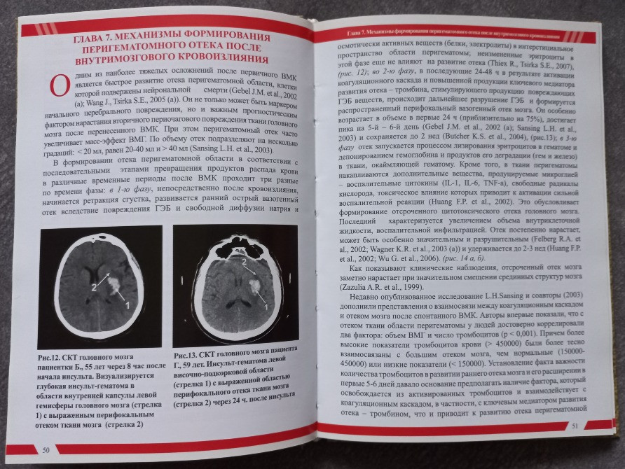 Острые спонтанные супратенториальные внутримозговые кровоизлияния. Винничук С.М., Пустовая О.А., Рог Харків - зображення 6