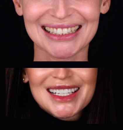 Сучасні вініри усіх типів у Києві - стоматологія Sa-Nata Київ