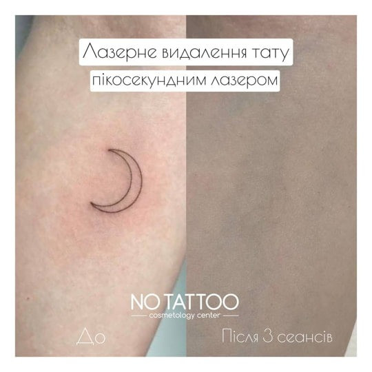 Видалення татуюваннь та татуажу(брови, повіки, губи) Киев - изображение 2